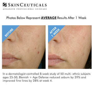 SKINCEUTICALS BLEMISH + AGE DEFENSE AT PEBBLE AESTHETIC