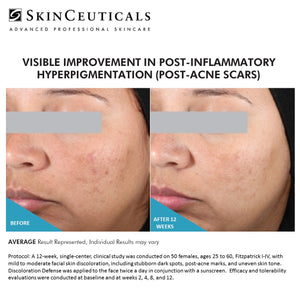 SKINCEUTICALS DISCOLORATION DEFENSE AT PEBBLE AESTHETIC